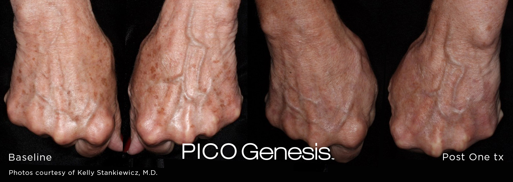 enlighten pico genesis 11