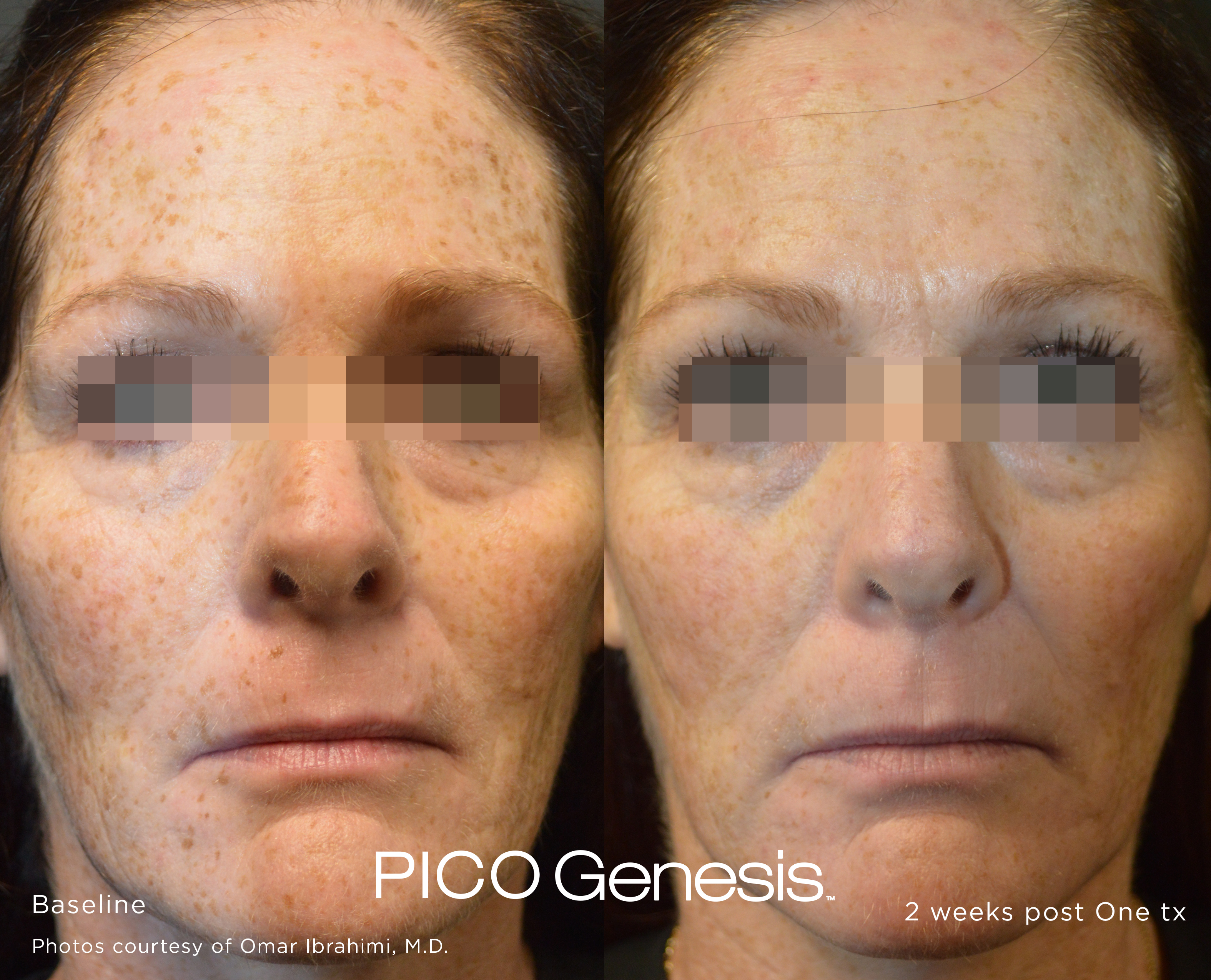 enlighten pico genesis 13