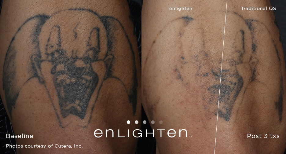 enlighten Tattoo Clown Post 12 weeks 3 tx