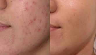 Skin Problem Acne
